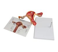Uterine Lesion Model - Human Pathological Uterus and Ovary Model for Teaching and Learning - Female Reproductive Organs Medical Tool