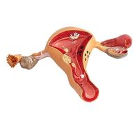 Uterus Ovary Model Female Reproductive Organs, Human Pathological Uterus Ovary Model, Anatomical Model, Anatomy Disease Pathology for Teaching Learning