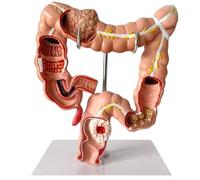 Uzztfa Human Large Intestine Anatomical Model Visceral Lesion Model, Colon Pathology Model Human Anatomical Anatomy Digestive System Studying Teaching Model