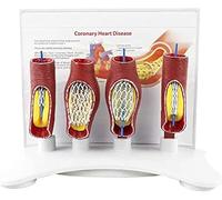Vascular Blockage Model, Vascular Stent Model, Human Coronary Stent Model, Human Vessel Enlargement Demonstration Model, for Medical Educational Surgical Simulation Tool