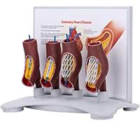 Vascular Stent Model, Coronary Heart Disease Demonstration Set, Human Vessel Enlargement Demonstration Model, Vascular Blockage Model, Vascular Occlusion Model for Educational Training Aid