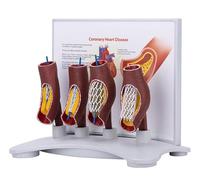 Vascular Stent Model, Vascular Blockage Model, Human Coronary Stent Model, Human Vessel Enlargement Demonstration Model for Educational