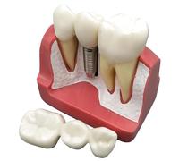 Vestamore Patient Education Model, 4 Times Dental Implant and Crown Bridge, Detachable Restorations, Enlarged Teaching Demonstration, 16 X 8 X 7.3 Cm / 6.3 X 3.1 X 2.9 in