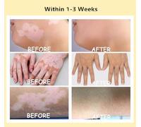 Vitiligo Spray, Skin Freckle Cream, Vitiligo Treatment Spray, Professional White Spot Remover for Skin, Natural VItiligo Organics Sprays, Reduce White Spots and Improve Skin Pigmentation (3Pcs)