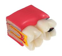 Warmhm Caries Tooth Decay Model for Patient Education Anatomy Teaching Tool with Comparative Healthy and Decayed Teeth for Schools Clinics and Oral Health Training