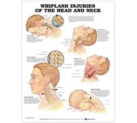 Whiplash Injuries Of Head & Neck Chart