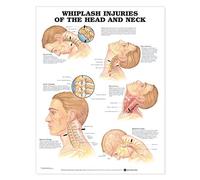 Whiplash Injuries of the Head and Neck