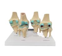 WHOOLEFUN 4 Stage Knee Joint Disease Model, Human Knee Pathological Model, Osteoarthritis Anatomical Model, with English Back Card, Teaching Tool for Medical Students
