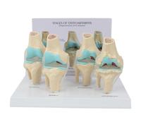 WHOOLEFUN 4-stage Knee Joint Disease Model, PVC Life Size Lesion Knee Joint Model, Osteoarthritis Anatomical Model, with Back Card and Display Base, for Study Display Teaching