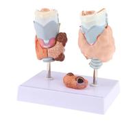 WHOOLEFUN Thyroid Pathology Model, Thyroid Throat Tumor Cyst Model, Human Thyroid Normal & Pathological Anatomy Model, Endocrine Disease Teaching, for Medical Teaching