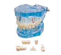 Windplusya Transparent Disease Teeth Model with Dental Implant Bridge, Dental Teach Crown Bridge Removable Model, Tooth Model for Patient and Dental Student Education. (blue)