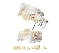 Windplusya Transparent Disease Teeth Model with Dental Implant Bridge, Dental Teach Crown Bridge Removable Model, Tooth Model for Patient and Dental Student Education. (transparent)