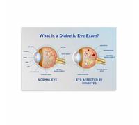 XTVVTODJXT Diabetic Retinopathy Reference Chart Diabetes Eye Health Educational Poster for Doctors Office Classroom Wall-Art(Framed,12x18inch(30x45cm))