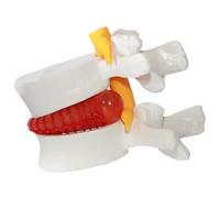 Xweptuy Herniated Disc Relief Teaching Aids, PVC Human Body Model of Herniated Lumbar Vertebrae Disc, 1.5 Times Life Size Lumbar Spine Model for Teaching, Learning and Demonstrating