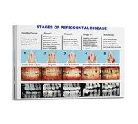 YiXong Dental Clinic Periodontal Disease Staging Chart Poster Decorative Painting Canvas Wall Posters And Art Picture Print Modern Family Bedroom Decor Posters 08x12inch(20x30cm)