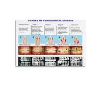 YiXong Dental Clinic Periodontal Disease Staging Chart Poster Decorative Painting Canvas Wall Posters And Art Picture Print Modern Family Bedroom Decor Posters 20x30inch(50x75cm)