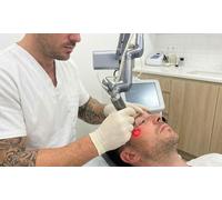 Young Skin Rejuvenation Co2 Laser Treatment