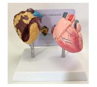 YTUK Human Smoking Heart And Healthy Heart Comparison Model,Human Organ Anatomy Model, Heart Model, For Learning, Display And Teaching Medicine
