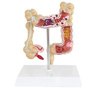 YUANZHOU Colon Disease Model Large Intestine Pathological Model Rectum Appendix Model Anorectal Doctor-patient Communication Model