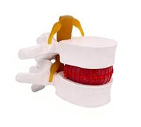YXHXWKJ Human Anatomical Lumbar Disc Herniation Model-1.5 Times Life Size Lumbar Disc Teaching Model Tool For Medical &Teaching & Learning And Scientific Presentations(White)