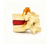 YXHXWKJ Human Anatomical Lumbar Disc Herniation Model-1.5 Times Life Size Lumbar Disc Teaching Model Tool For Medical &Teaching & Learning And Scientific Presentations(Bone yellow)