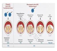 YZWRWRMKTB Obstetric Knowledge Placentation of Twins Chart Educational Poster Anatomy Canvas for Consultation Room Decor(Unframed,08x12inch(20x30cm))