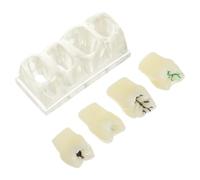 Zerodeko Caries Teeth Model with Detachable Decayed Teeth and Abs Material for Oral Hygiene Teaching and Patient Communication Educational Oral Study Model for Dental Students and Health