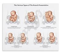 ZGPOSQKZSC Obstetric Reference Poster Breech Presentation Frank Complete Footling Types for Maternity Ward Skills(Unframed,08x12inch(20x30cm))